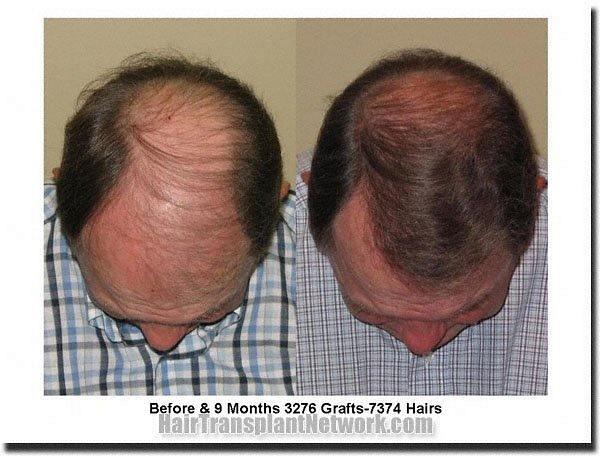 Hair restoration procedure results