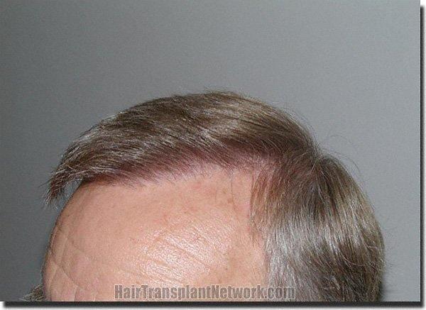 Hair restoration procedure results