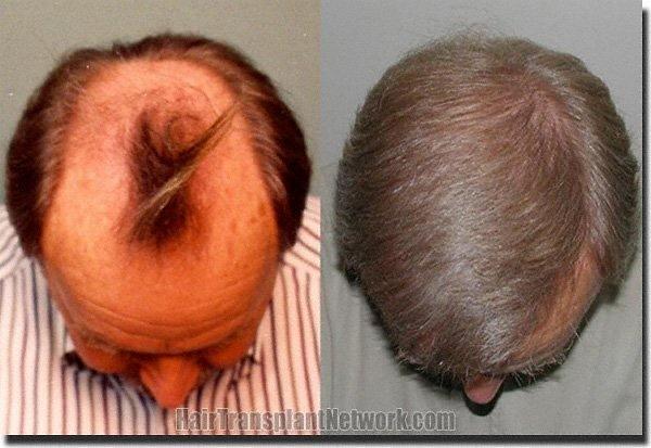 Hair restoration procedure results