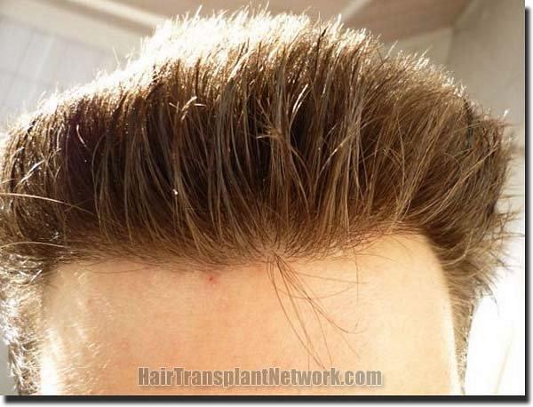 Hair restoration procedure results