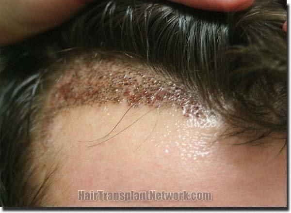 Hair restoration procedure results