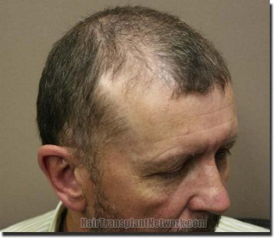 Hair restoration procedure results