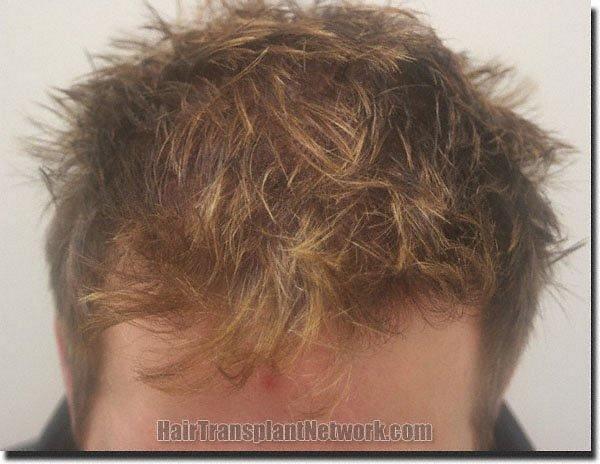 Hair restoration procedure results