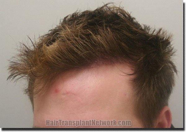 Hair restoration procedure results