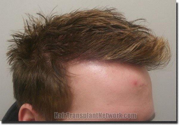 Hair restoration procedure results