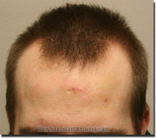 Hair restoration procedure results