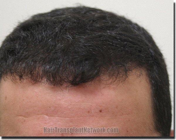 Hair restoration procedure results