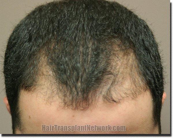 Hair restoration procedure results