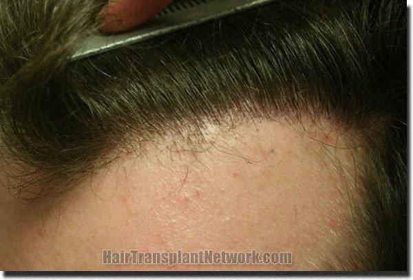 Hair restoration procedure results