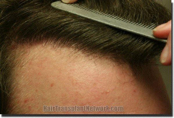 Hair restoration procedure results