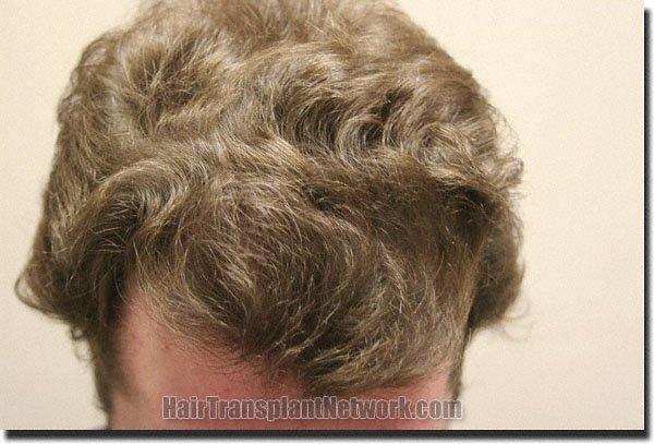 Hair restoration procedure results