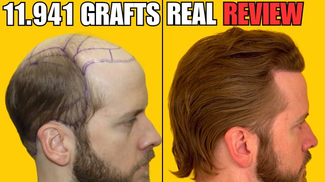 Where To Find Real Hair Transplant Reviews