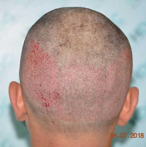 donor area after 3070 follicular units extracted