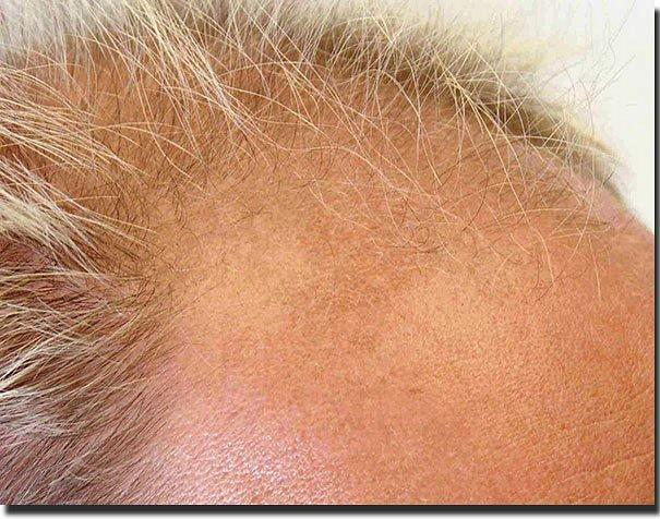 Hair restoration procedure results