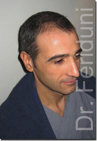 Hair restoration procedure results