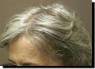 Hair restoration procedure results