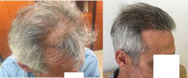 Right view before and after hair transplant surgery