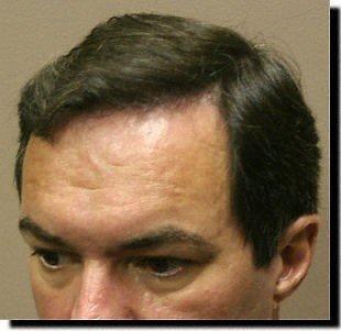 Hair restoration procedure results