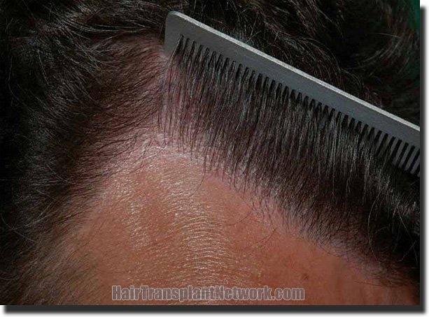 Hair restoration procedure results