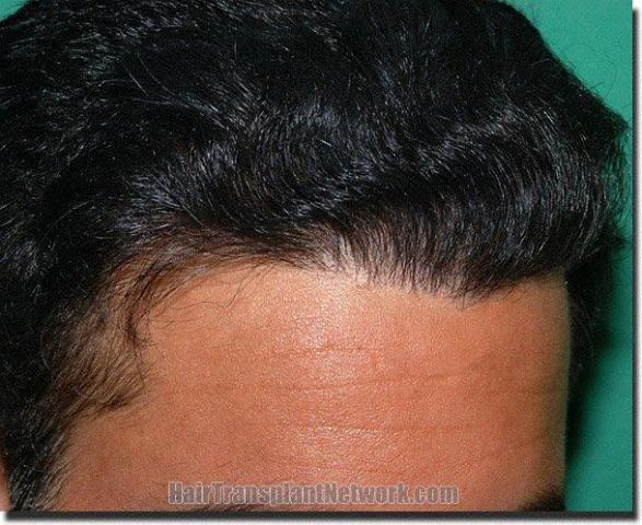 Hair restoration procedure results