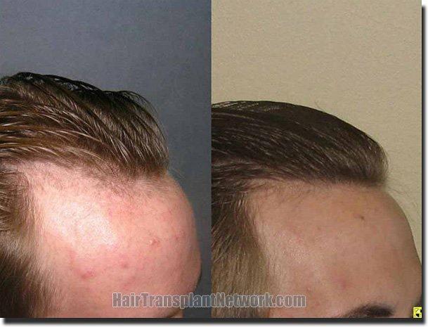 Hair restoration procedure results