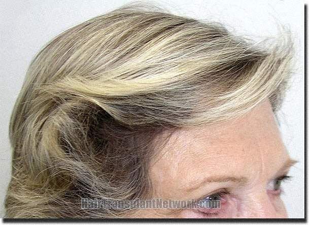 Hair restoration procedure results