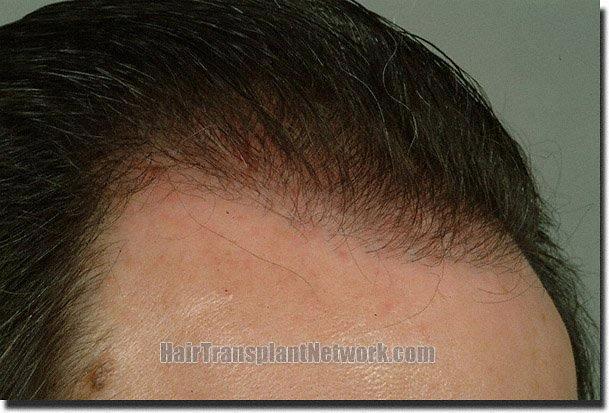 Hair restoration procedure results