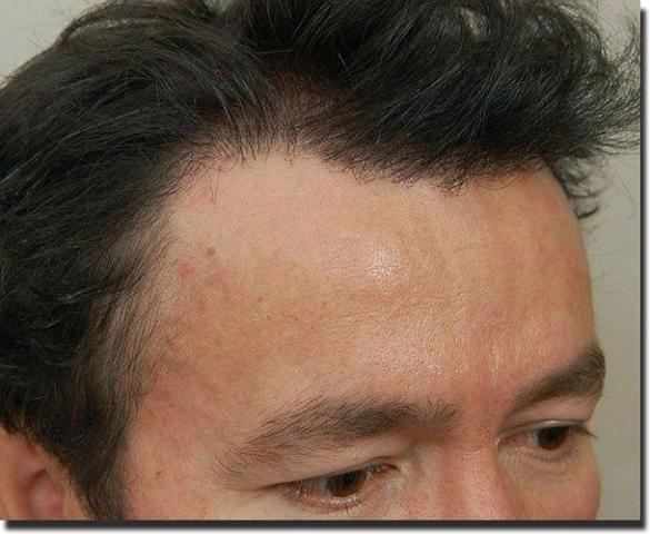 Hair restoration procedure results