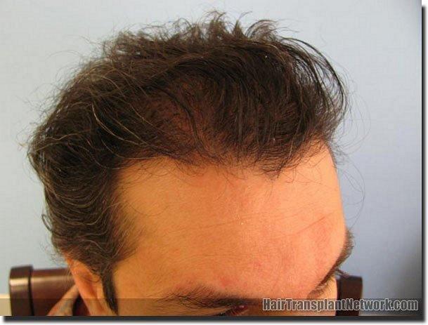 Hair restoration procedure results