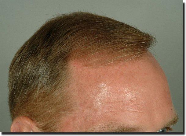 Hair restoration procedure results