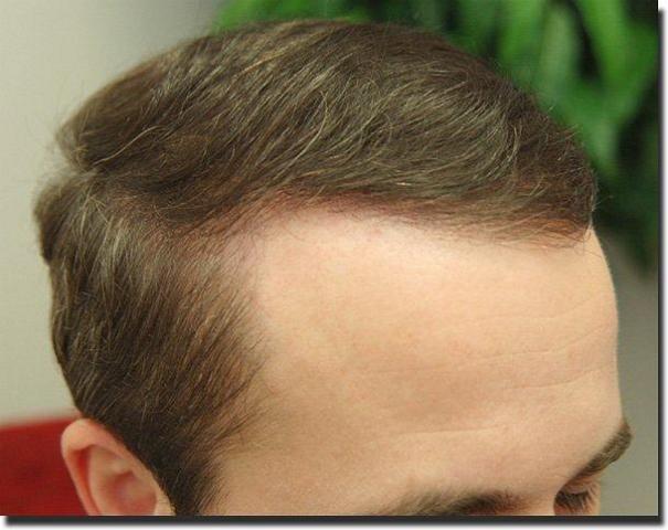 Hair restoration procedure results