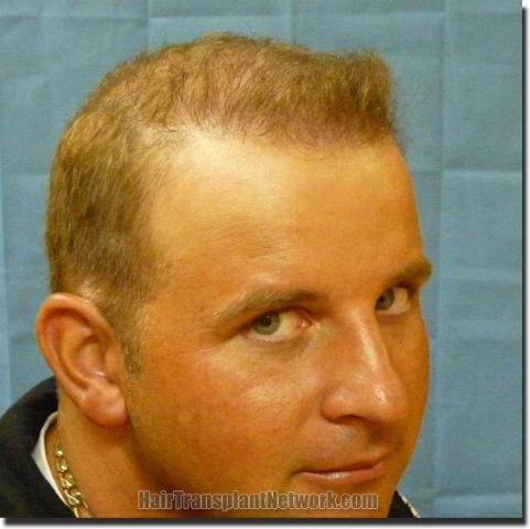 Hair restoration procedure results