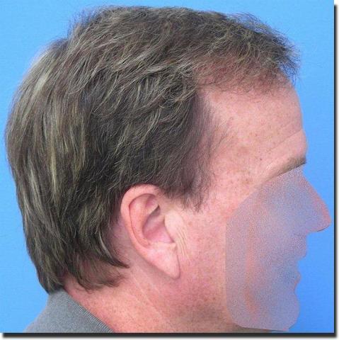 Hair restoration procedure results