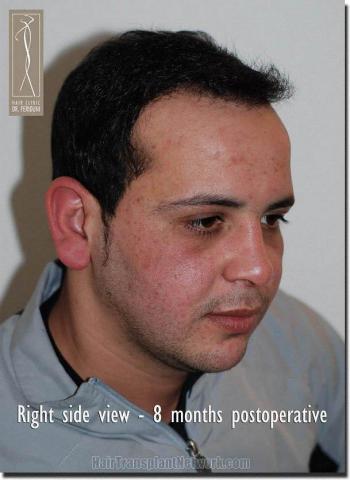 Hair restoration procedure results