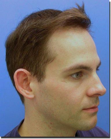 Hair restoration procedure results