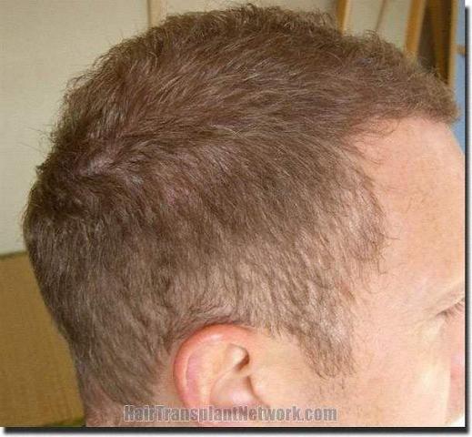 Hair restoration procedure results