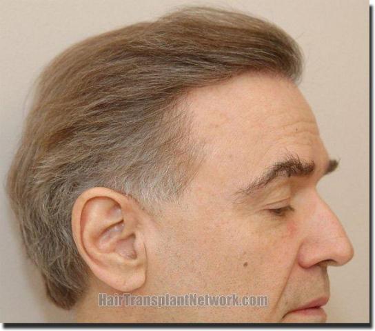 Hair restoration procedure results