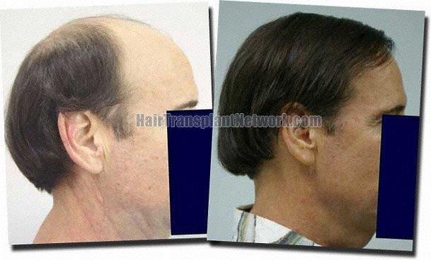 Hair restoration procedure results