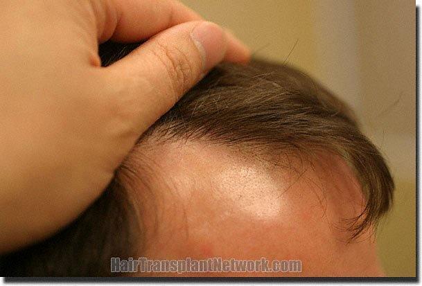 Hair restoration procedure results