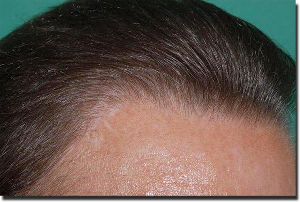 Hair restoration procedure results