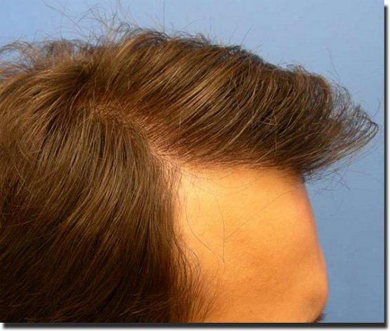 Hair restoration procedure results