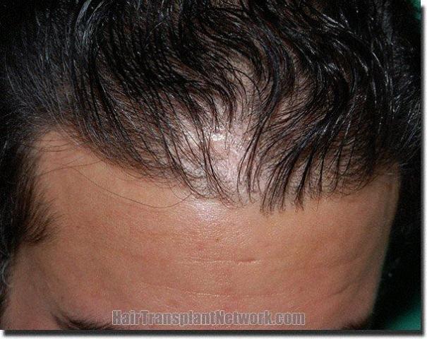 Hair restoration procedure results