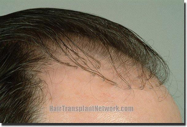 Hair restoration procedure results