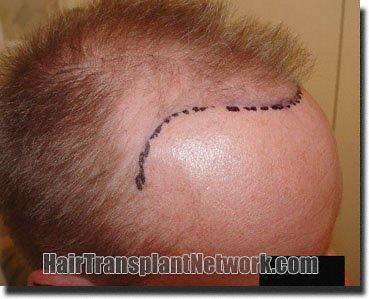 Hair restoration procedure results