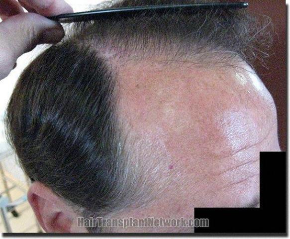 Hair restoration procedure results