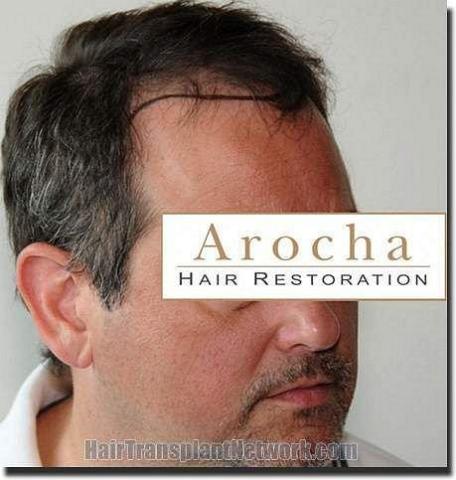 Hair restoration procedure results