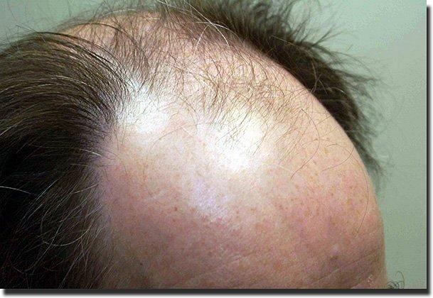 Hair restoration procedure results