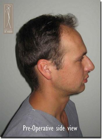 Hair restoration procedure results