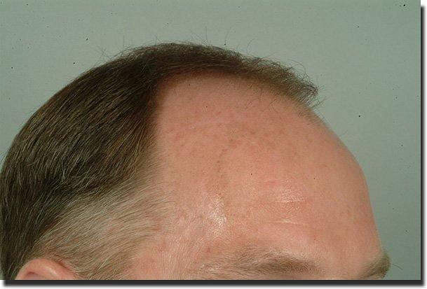 Hair restoration procedure results