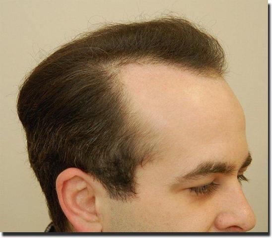 Hair restoration procedure results